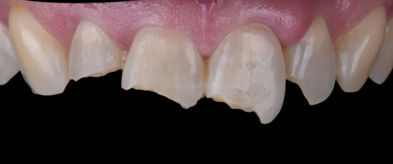 Composite-Bonding-01-768x320