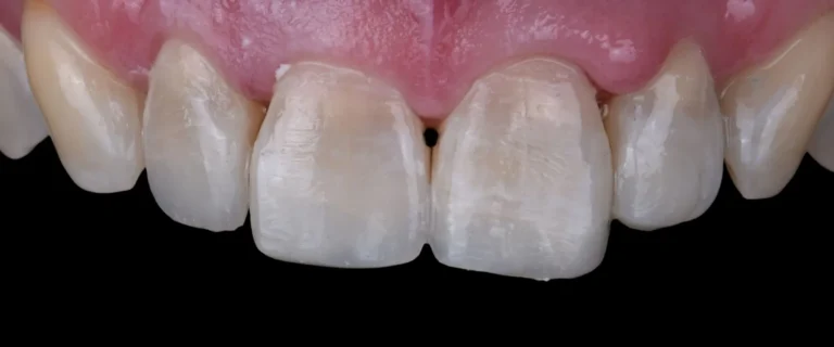 Composite-Bonding-02-768x320