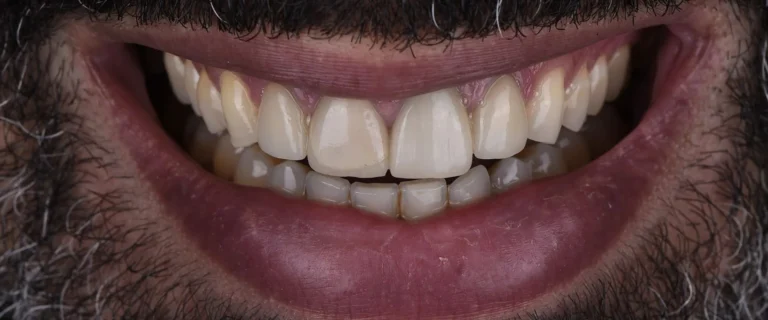 Crowns-and-Veneers-1-768x320
