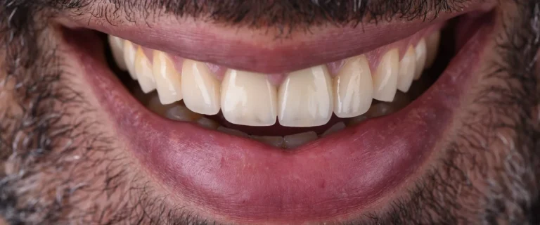 Crowns-and-Veneers-2-768x320