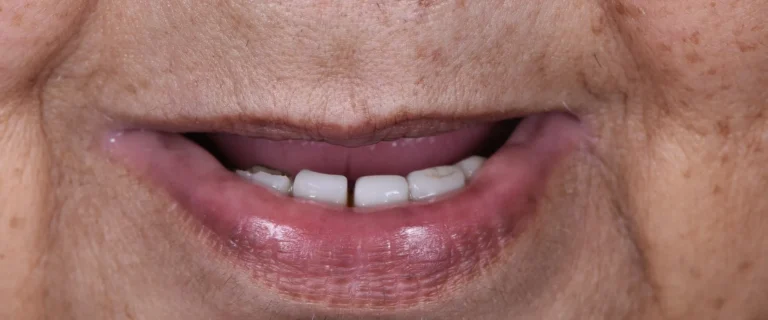 Rehabilitation-over-Implants-1-768x320