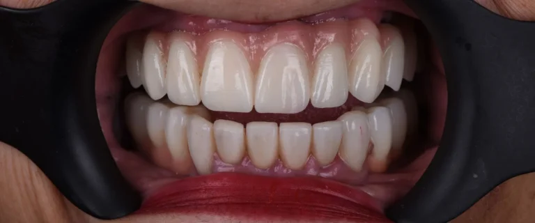 Rehabilitation-over-Implants-2-768x320